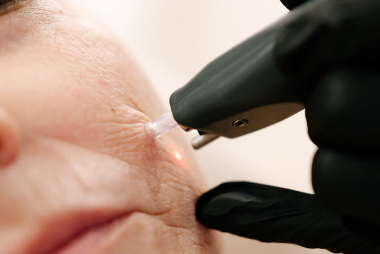 SuperBoost-behandling hos LNDA Skin Clinic