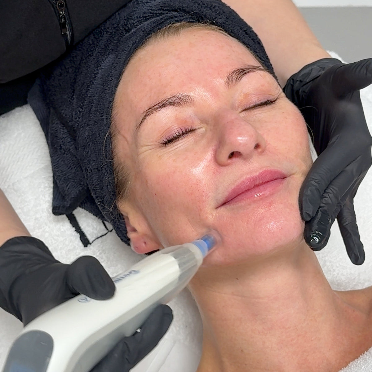 Microneedling med Dermapen 4 – LNDA Skin Clinic